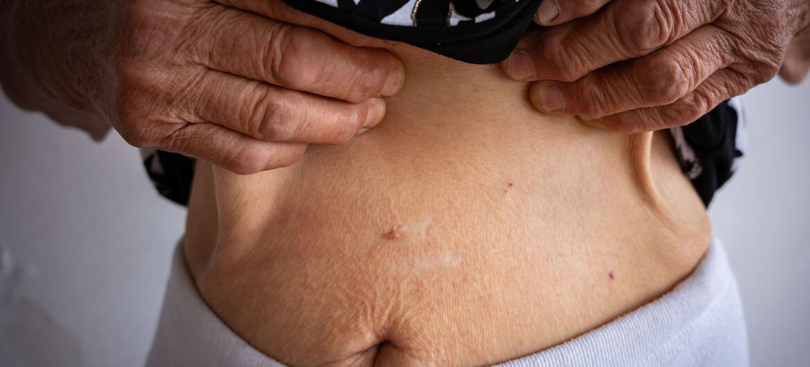 Close-up of an elderly woman's torso showing a scar on her abdomen, hands lifting her shirt to reveal the mark, symbolizing trauma from sexual violence during war in Ukraine.