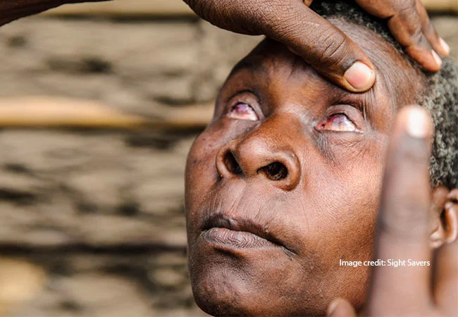 NGO performs 315,000 eye surgeries in one year